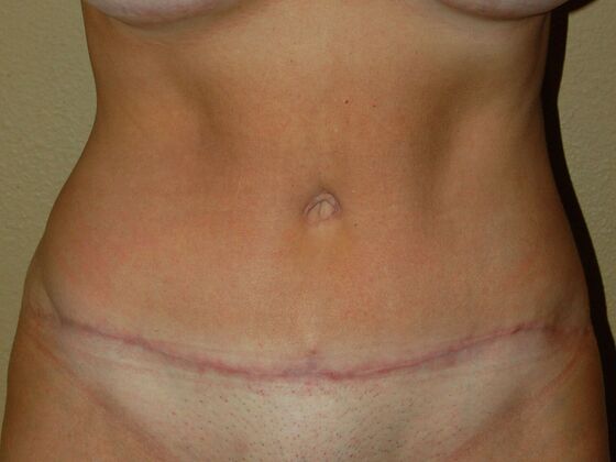 Tummy Tuck (Abdominoplasty) Case 8 - After