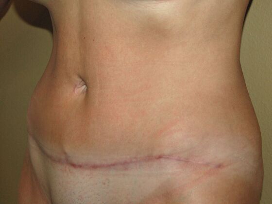 Tummy Tuck (Abdominoplasty): Case 8 - Tummy Tuck After