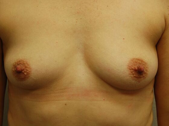 Breast Augmentation: Case 71 - Before Breast Augmentation