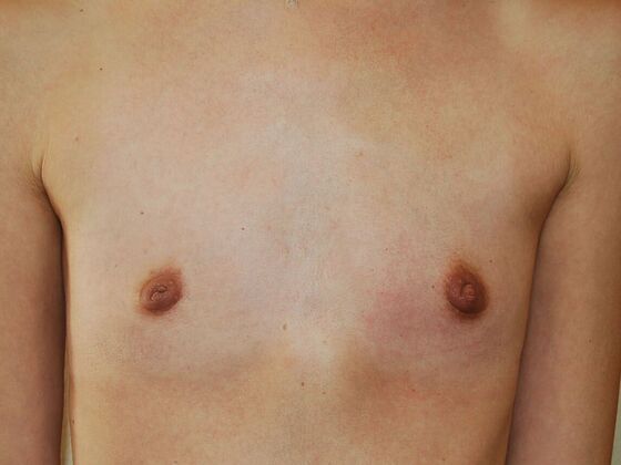 Breast Augmentation: Case 75 - Before Breast Augmentation