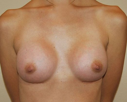 Breast Augmentation Case 75 - After