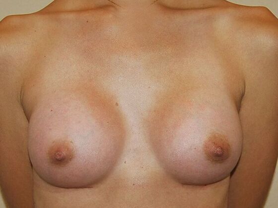 Breast Augmentation: Case 75 - After Breast Augmentation