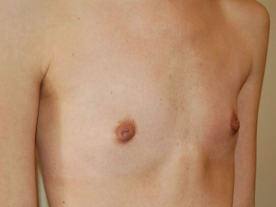 Breast Augmentation: Case 75 - Before Breast Augmentation