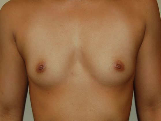 Breast Augmentation Case 81 - Before