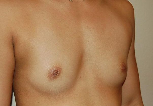 Breast Augmentation: Case 81 - Before Breast Augmentation