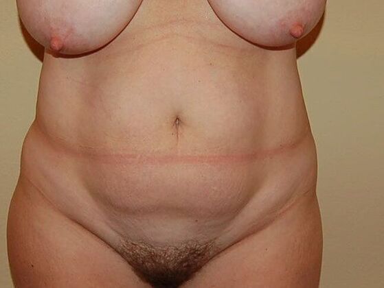 Tummy Tuck (Abdominoplasty) Case 11 - Before