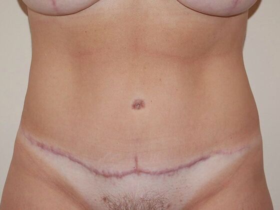 Tummy Tuck (Abdominoplasty) Case 11 - After