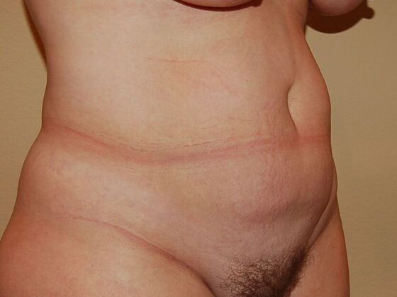 Tummy Tuck (Abdominoplasty): Case 11 - Tummy Tuck Before