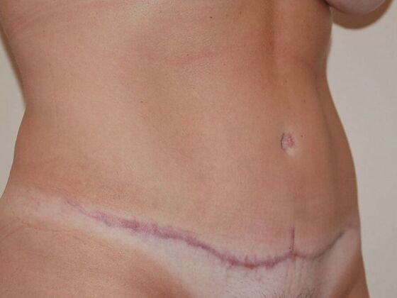 Tummy Tuck (Abdominoplasty): Case 11 - Tummy Tuck After