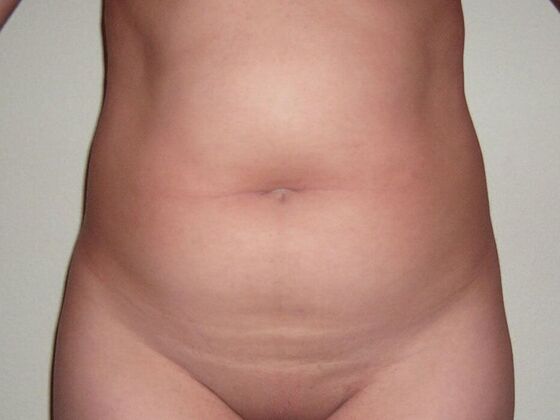 Tummy Tuck (Abdominoplasty) Case 15 - Before