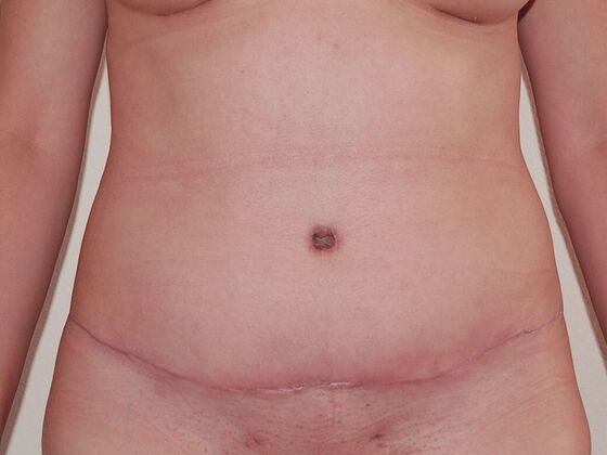 Tummy Tuck (Abdominoplasty) Case 15 - After