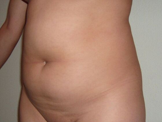Tummy Tuck (Abdominoplasty): Case 15 - Tummy Tuck Before