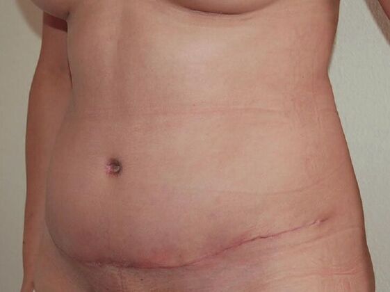 Tummy Tuck (Abdominoplasty): Case 15 - Tummy Tuck After