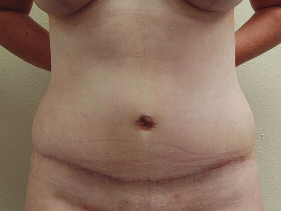 Tummy Tuck (Abdominoplasty) Case 17 - After