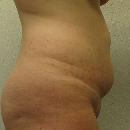Tummy Tuck (Abdominoplasty): Case 17 - Tummy Tuck Before