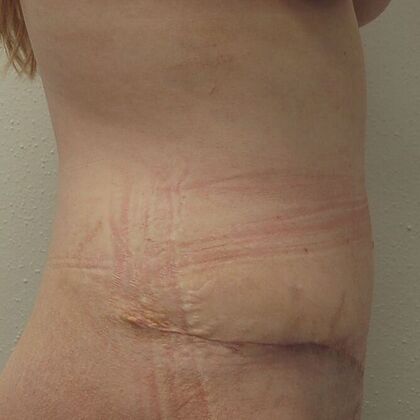 Tummy Tuck (Abdominoplasty): Case 17 - Tummy Tuck After