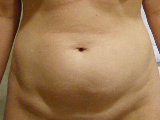 Tummy Tuck (Abdominoplasty) Case 18 - Before