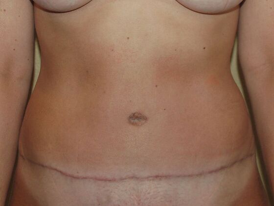 Tummy Tuck (Abdominoplasty) Case 18 - After