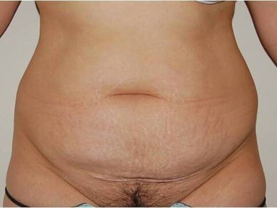 Tummy Tuck (Abdominoplasty) Case 20 - Before