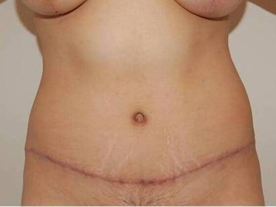 Tummy Tuck (Abdominoplasty) Case 20 - After