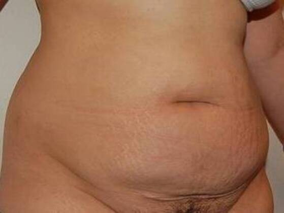 Tummy Tuck (Abdominoplasty): Case 20 - Tummy Tuck Before