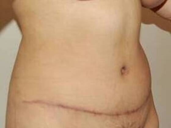 Tummy Tuck (Abdominoplasty): Case 20 - Tummy Tuck After