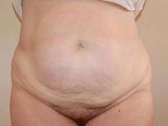 Tummy Tuck (Abdominoplasty) Case 21 - Before