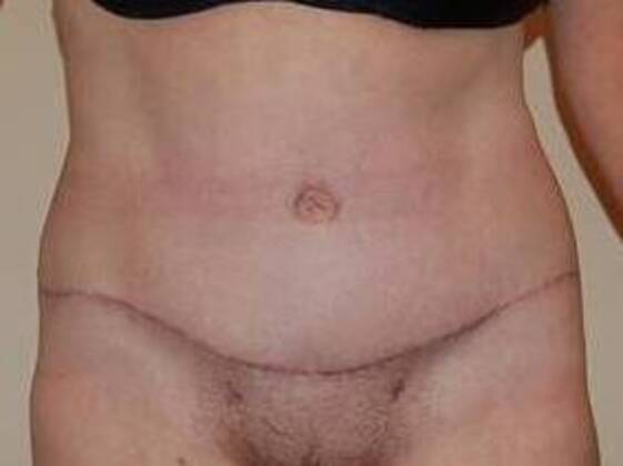 Tummy Tuck (Abdominoplasty) Case 21 - After