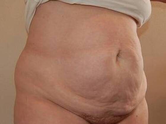 Tummy Tuck (Abdominoplasty): Case 21 - Tummy Tuck Before