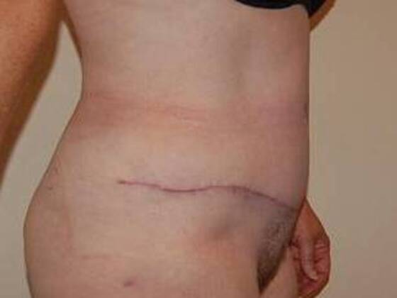 Tummy Tuck (Abdominoplasty): Case 21 - Tummy Tuck After