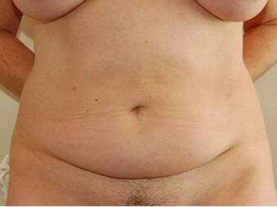 Tummy Tuck (Abdominoplasty) Case 22 - Before