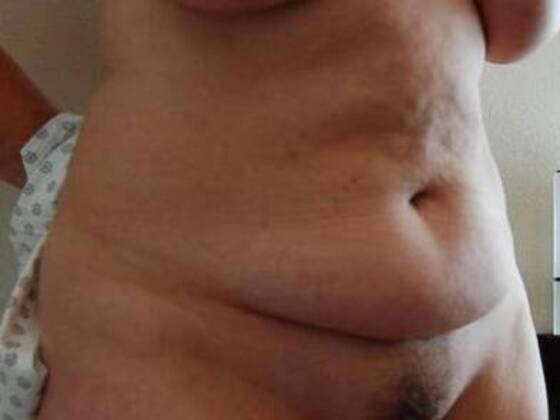 Tummy Tuck (Abdominoplasty): Case 22 - Tummy Tuck Before