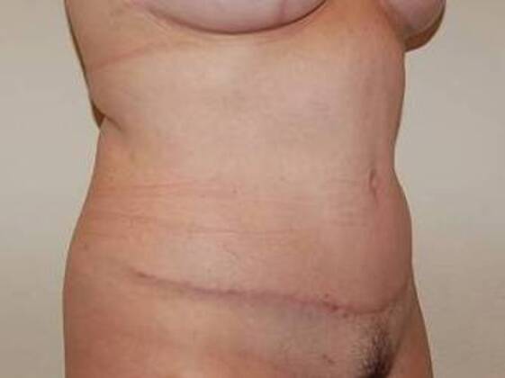Tummy Tuck (Abdominoplasty): Case 22 - Tummy Tuck After