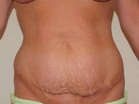 Tummy Tuck (Abdominoplasty): Case 573 - Tummy Tuck Before