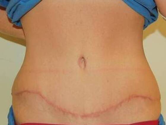 Tummy Tuck (Abdominoplasty): Case 573 - Tummy Tuck After