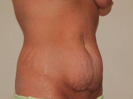 Tummy Tuck (Abdominoplasty): Case 573 - Tummy Tuck Before
