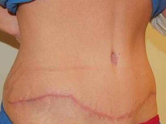 Tummy Tuck (Abdominoplasty): Case 573 - Tummy Tuck After