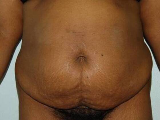 Tummy Tuck (Abdominoplasty): Case 195 - Tummy Tuck Before