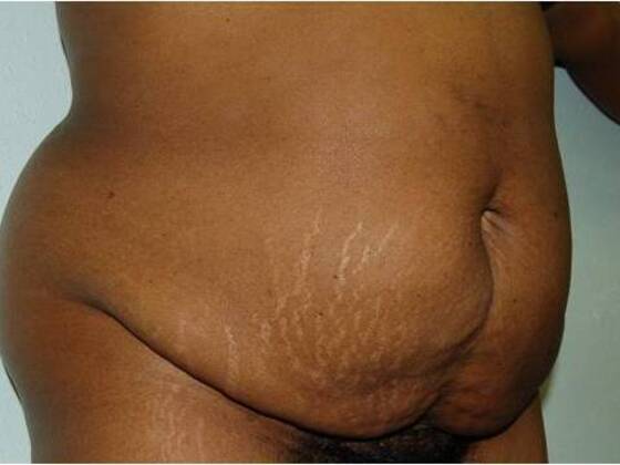 Tummy Tuck (Abdominoplasty): Case 195 - Tummy Tuck Before