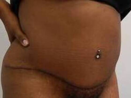 Tummy Tuck (Abdominoplasty): Case 195 - Tummy Tuck After