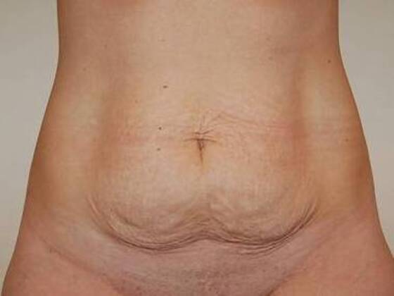 Tummy Tuck (Abdominoplasty) Case 25 - Before