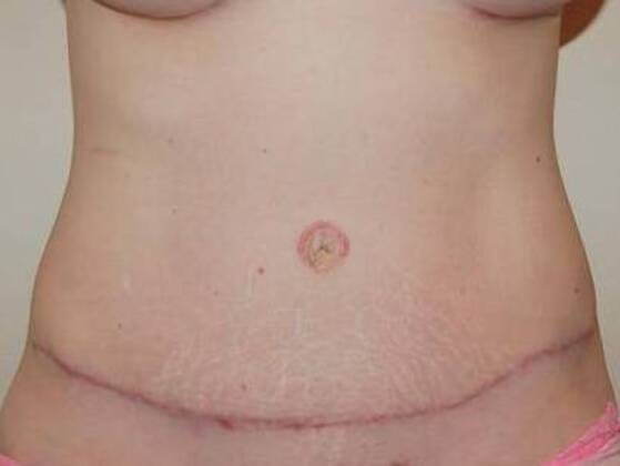 Tummy Tuck (Abdominoplasty) Case 25 - After