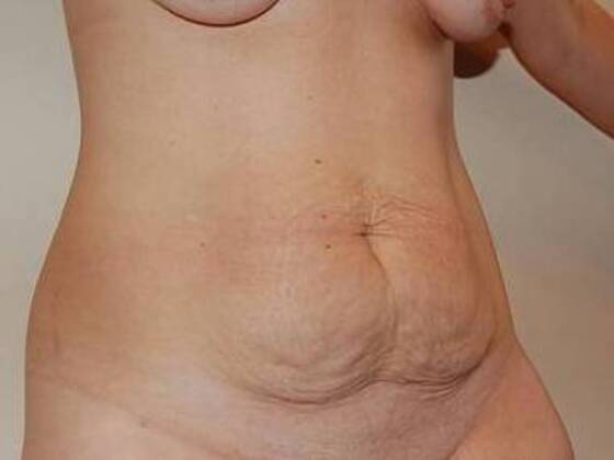 Tummy Tuck (Abdominoplasty): Case 25 - Tummy Tuck Before