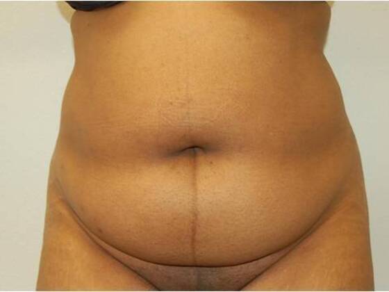 Tummy Tuck (Abdominoplasty) Case 26 - Before