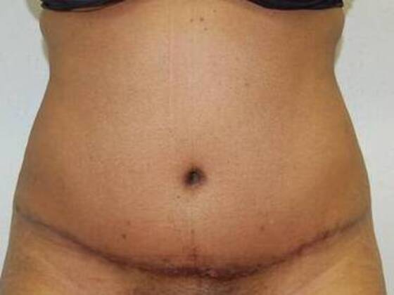 Tummy Tuck (Abdominoplasty) Case 26 - After