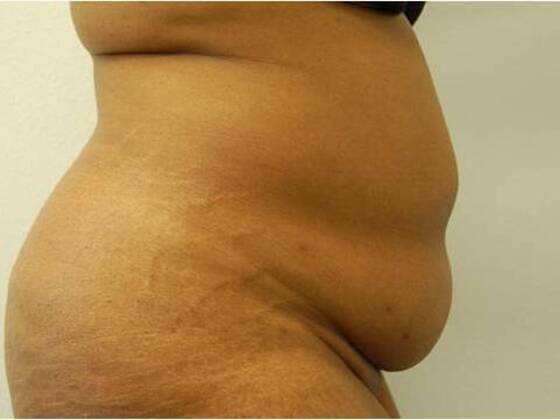 Tummy Tuck (Abdominoplasty): Case 26 - Tummy Tuck Before