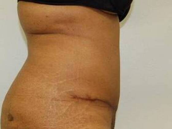 Tummy Tuck (Abdominoplasty): Case 26 - Tummy Tuck After
