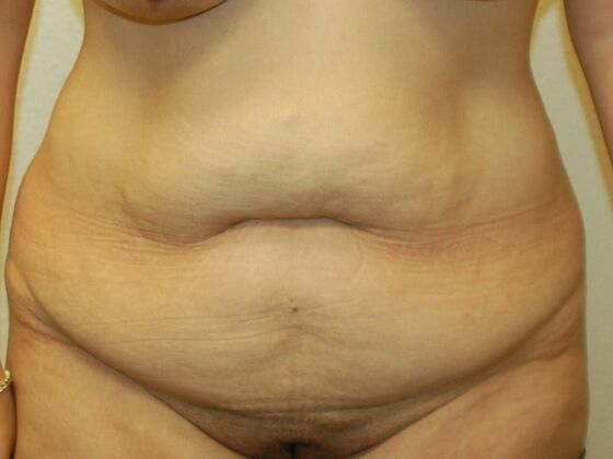 Tummy Tuck (Abdominoplasty) Case 28 - Before