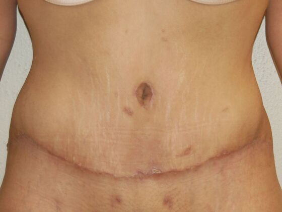 Tummy Tuck (Abdominoplasty) Case 28 - After