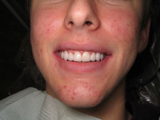 Smile Makeover Prep-less Veneers - After